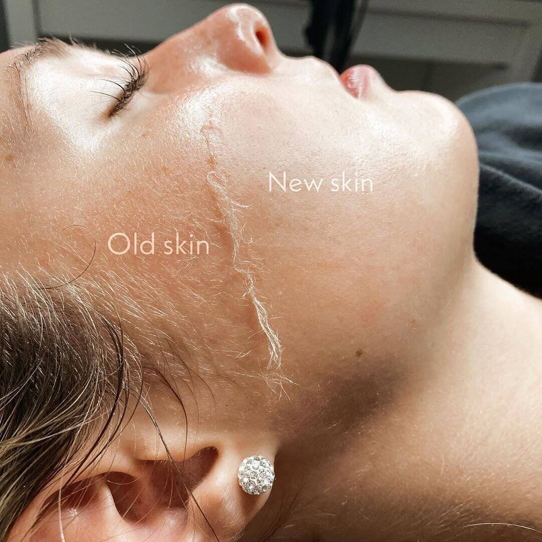 Dermaplaningnewskin_1708364656