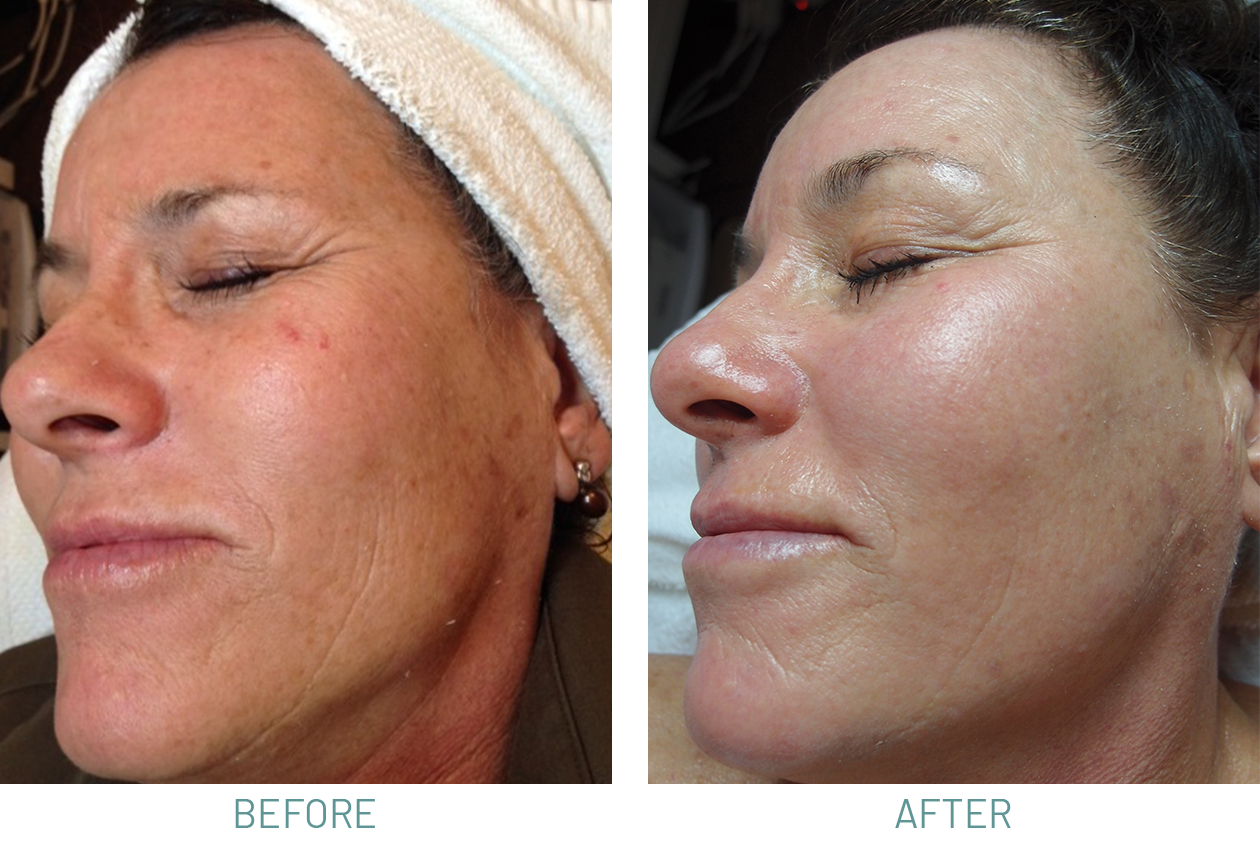 Microdermabrasion-Chemical-Peels-BEFOREAFTER