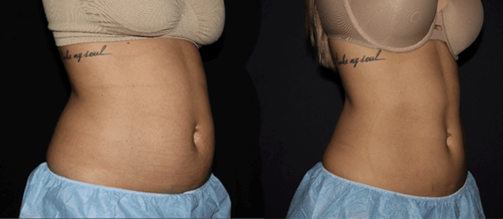 Non-Surgical-Body-Contouring-Before-And-After-1024x446