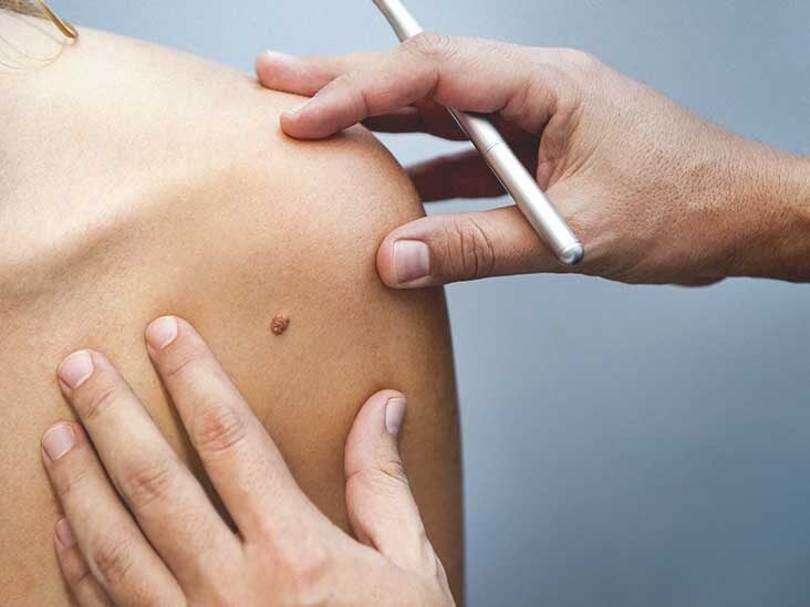 Skin-Tag-Removal