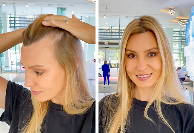 before-and-after-sapphire-hair-transplantation