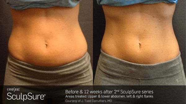 body-countouring-before-and-after-mid-section