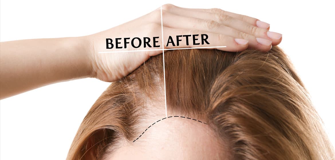 hairtransplantwoman