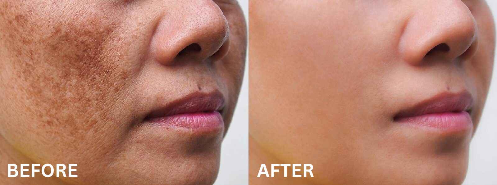 melasma_treatment_twacha_aesthetic_skin_clinic