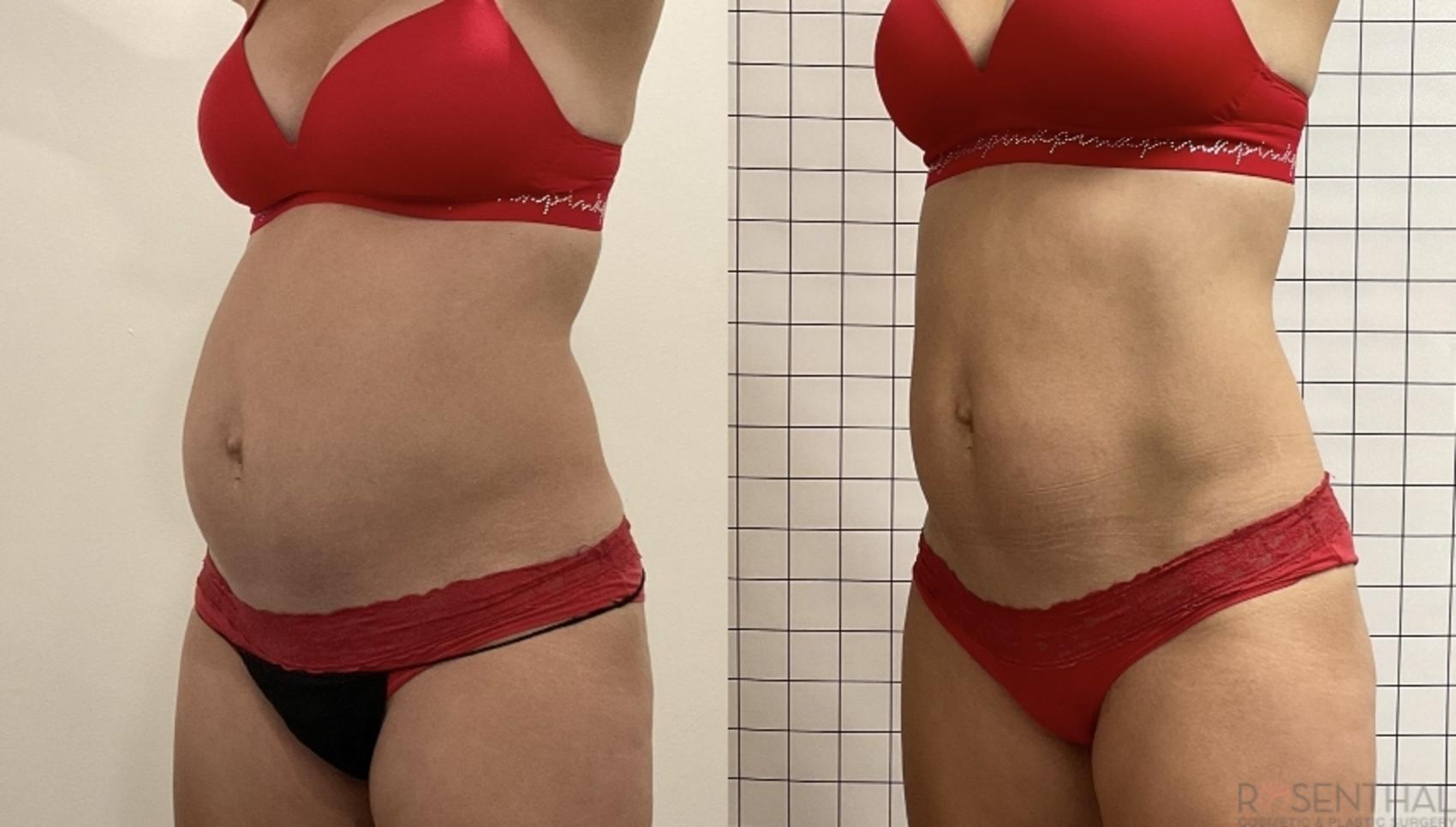 physiq-body-contouring-4-left-oblique-detail
